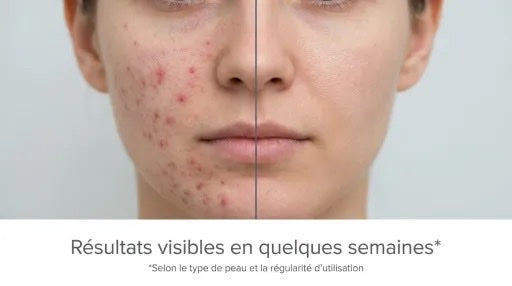 Lunéva Glow Pro Le rituel de lumière pour apaiser l’acné hormonale