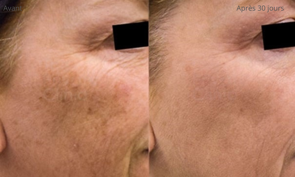 Lunéva Glow Pro – Masque LED 4 couleurs pour l'acné hormonale Lunéva