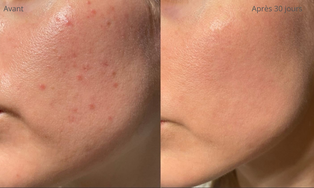 Lunéva Glow Pro – Masque LED 4 couleurs pour l'acné hormonale Lunéva