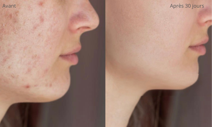 Lunéva Glow Pro – Masque LED 4 couleurs pour l'acné hormonale Lunéva