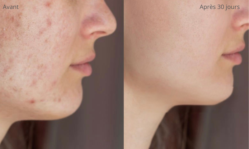 La luminothérapie LED offre une alternative naturelle et efficace