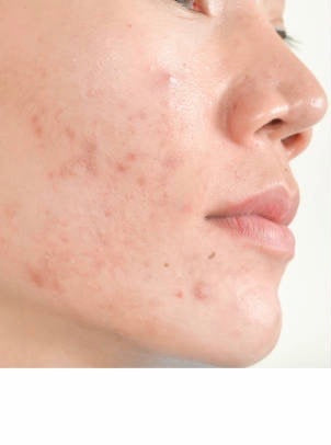 Zones les plus touchées par l'acné hormonale