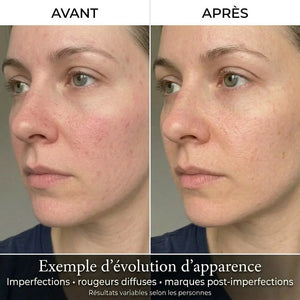 Lunéva Glow Pro — Masque LED visage premium (peau adulte : imperfections & rougeurs)